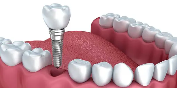 Giải pháp cho người mất răng bằng kỹ thuật trồng răng All On 4 tại nha khoa Thế Hệ Mới - Ảnh 2