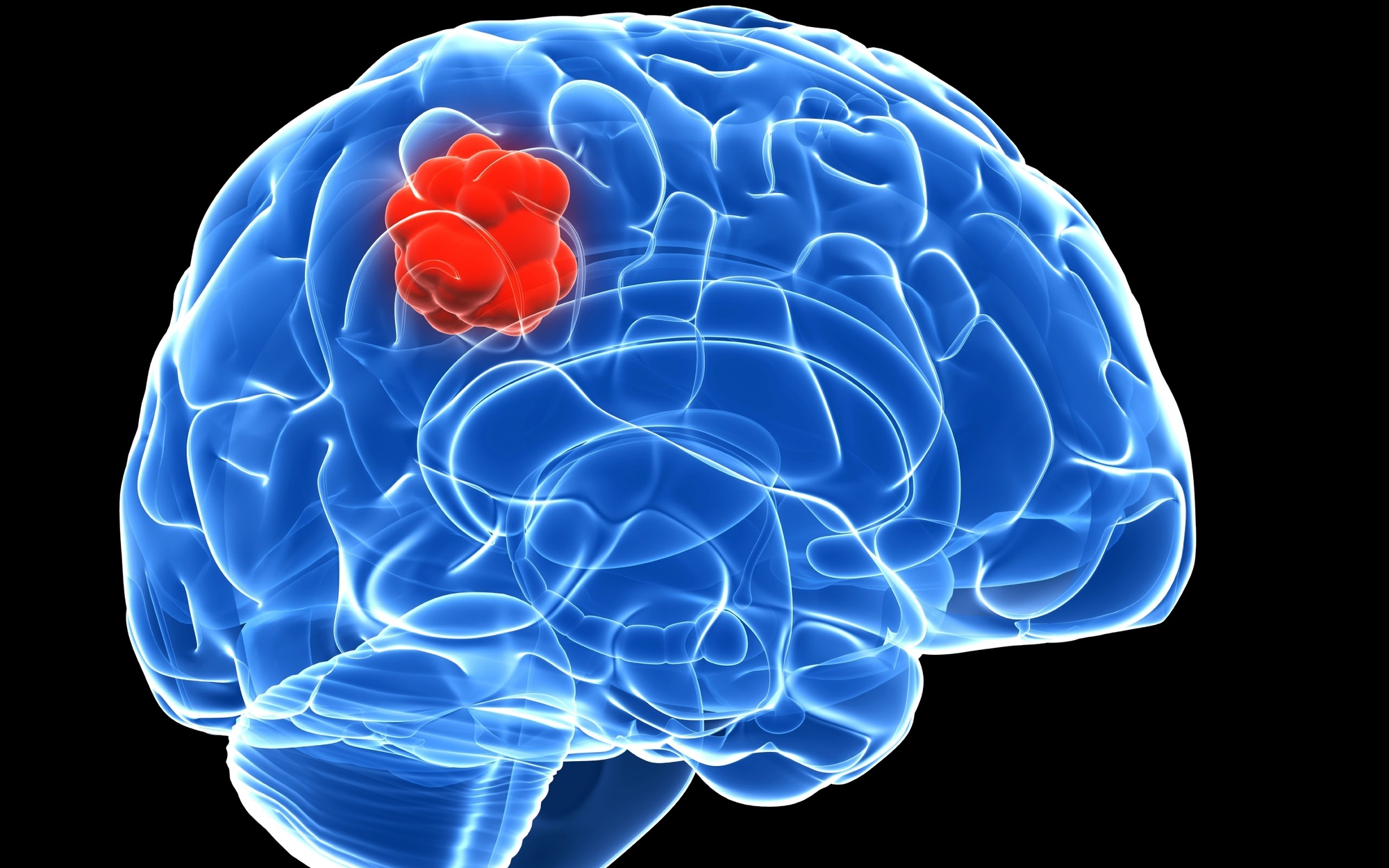 Người phụ nữ phát hiện u não từ dấu hiệu bất thường khi ngủ dậy - Ảnh 1