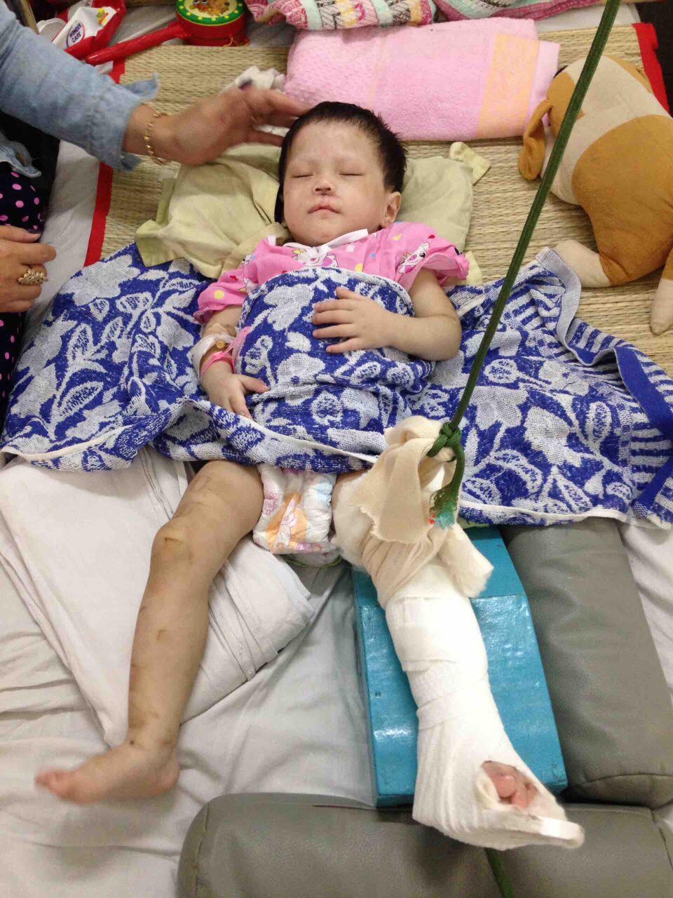 Bị cha mẹ bỏ rơi, bé gái 2 tuổi tiếp tục bị 'mẹ nuôi' đánh gãy chân, thương tật 60% chỉ vì biếng ăn, hay khóc - Ảnh 2