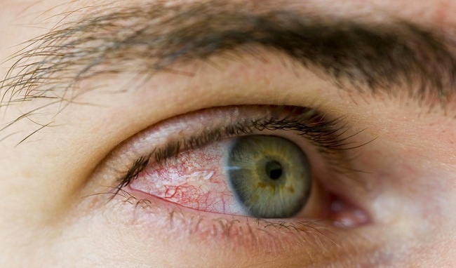 Ngoài thiếu ngủ, vệt đỏ trong mắt còn là dấu hiệu cảnh báo một số bệnh nguy hiểm - Ảnh 1