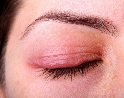 Ngoài thiếu ngủ, vệt đỏ trong mắt còn là dấu hiệu cảnh báo một số bệnh nguy hiểm - Ảnh 3