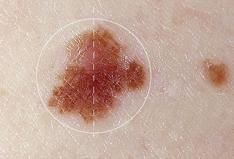 Cẩn thận với 5 dấu hiệu bất thường của nốt ruồi cũng có thể cảnh báo nguy cơ mắc bệnh ung thư da - Ảnh 1