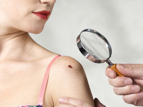 Cẩn thận với 5 dấu hiệu bất thường của nốt ruồi cũng có thể cảnh báo nguy cơ mắc bệnh ung thư da - Ảnh 4