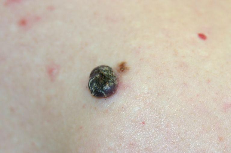 Cẩn thận với 5 dấu hiệu bất thường của nốt ruồi cũng có thể cảnh báo nguy cơ mắc bệnh ung thư da - Ảnh 5
