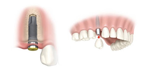 Cách để có giá trồng răng Implant rẻ nhất - Ảnh 1