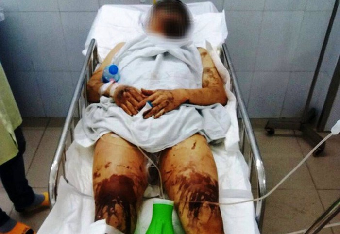 Vụ tạt axit, cắt gân chân Việt kiều vào mùng 5 Tết ở Quảng Ngãi: Lời kể hãi hùng của nạn nhân - Ảnh 3