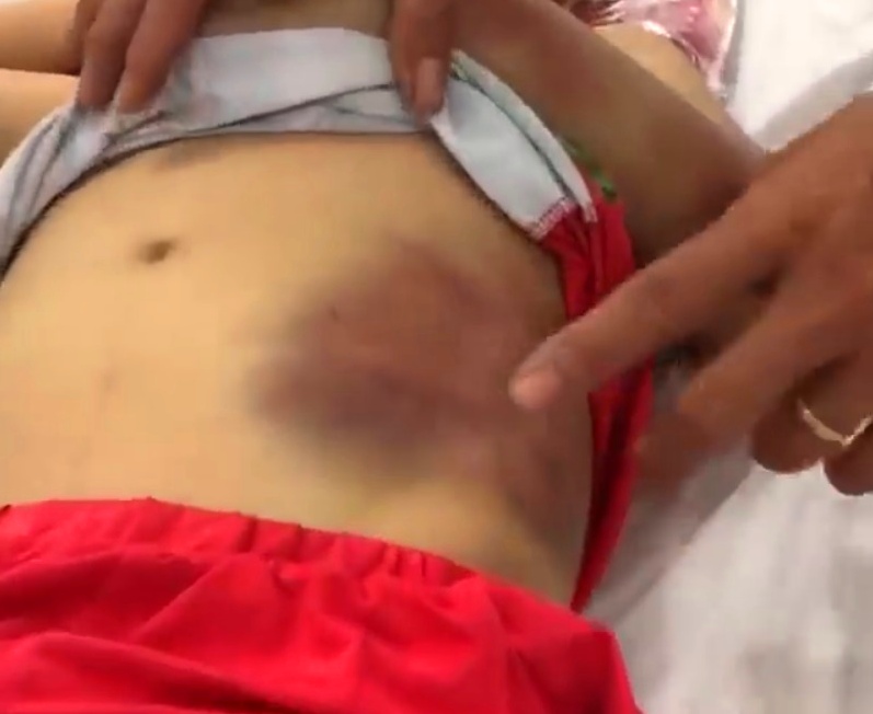 Tây Ninh: Mẹ ruột đánh đập con trai 6 tuổi bầm dập cả người - Ảnh 2