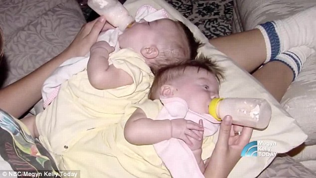 2 con gái sinh đôi dính liền, cha mẹ mất 7 tháng mới quyết định tách rời con, 17 năm sau ai cũng mãn nguyện khi thấy nụ cười của các em - Ảnh 3