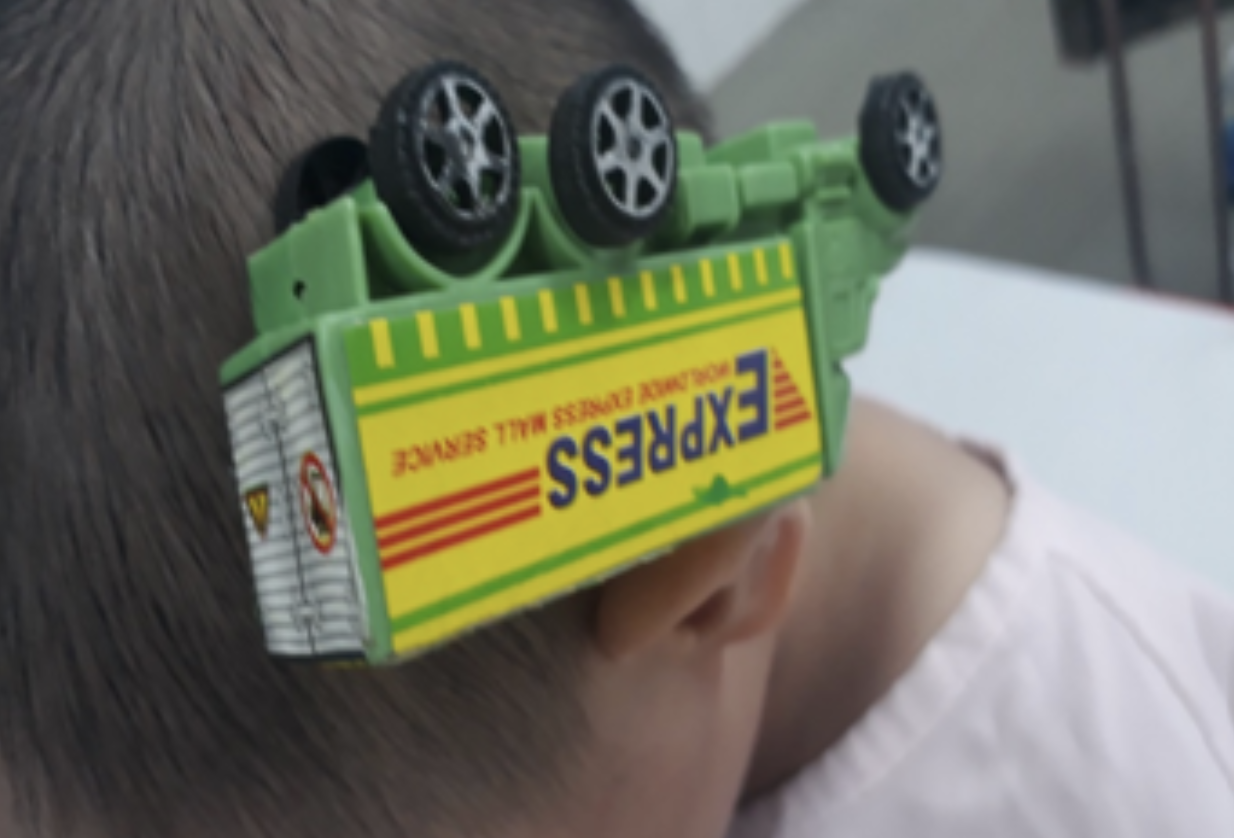 Hiểm họa khôn lường: Té ngã vào xe đồ chơi, bé trai 3 tuổi bị que sắt cắm thẳng vào đầu - Ảnh 1