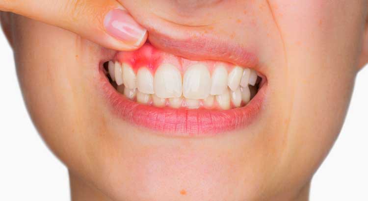 Những nguyên nhân cần lưu ý khi xuất hiện tình trạng chảy máu nướu khi đánh răng - Ảnh 1