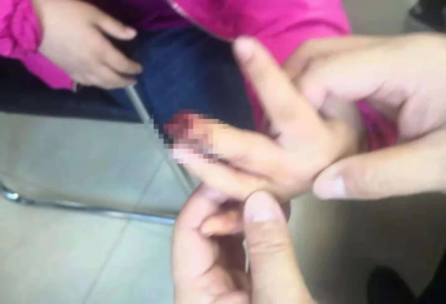 Bé gái 9 tuổi phải cưa ngón tay vì cách sơ cứu sai lầm của bà nội sau khi bị kẹt tay vào cửa - Ảnh 1