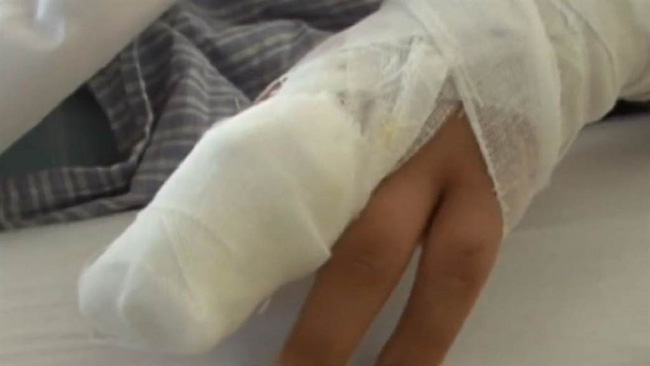 Bé gái 9 tuổi phải cưa ngón tay vì cách sơ cứu sai lầm của bà nội sau khi bị kẹt tay vào cửa - Ảnh 2