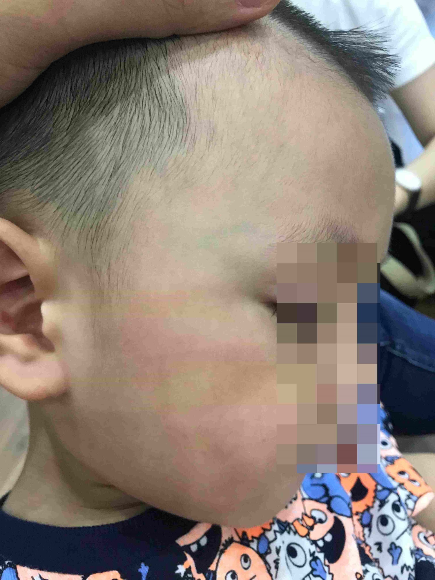 Trẻ 3 tuổi bị cô giáo tát in dấu tay trên mặt, tụ máu môi: 'Về nhà không ăn uống được, thấy cô giáo sợ hãi bỏ chạy' - Ảnh 1