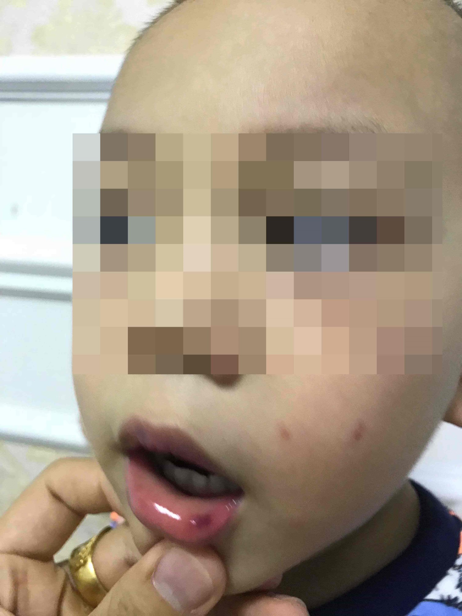 Trẻ 3 tuổi bị cô giáo tát in dấu tay trên mặt, tụ máu môi: 'Về nhà không ăn uống được, thấy cô giáo sợ hãi bỏ chạy' - Ảnh 3