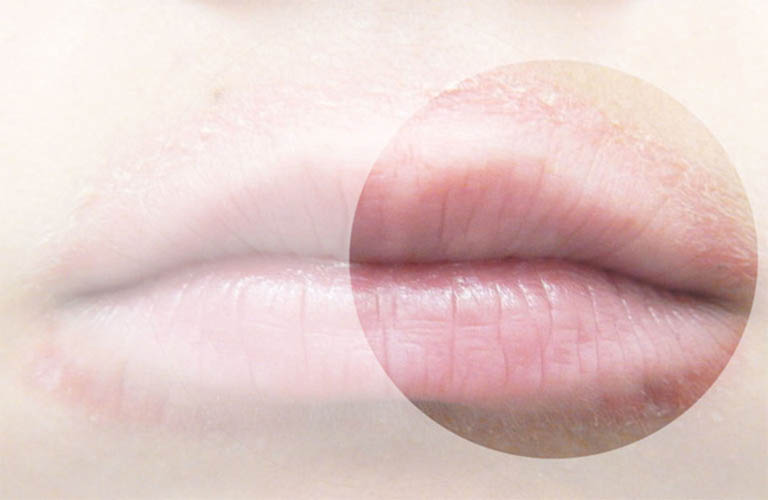 Vùng da quanh miệng bị đỏ là dấu hiệu của bệnh gì?