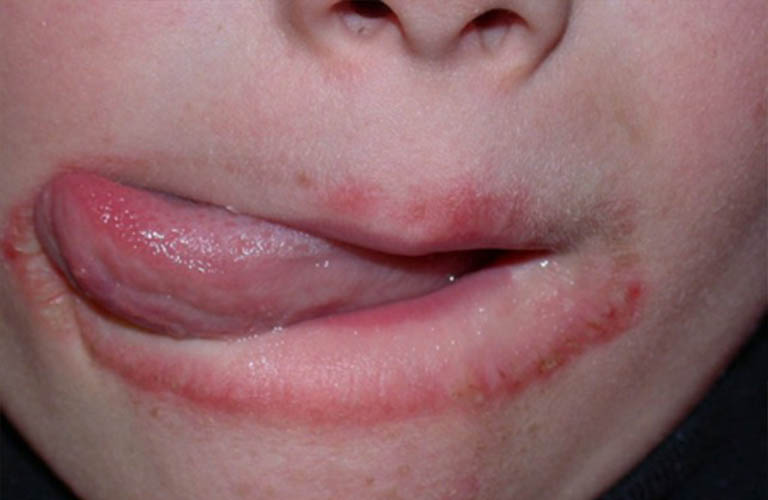 Các biện pháp phòng tránh vùng da quanh miệng bị đỏ hiệu quả