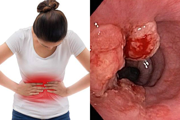 Đi khám vì đau bụng, thiếu nữ 16 tuổi phát hiện ung thư dạ dày di căn - Ảnh 1