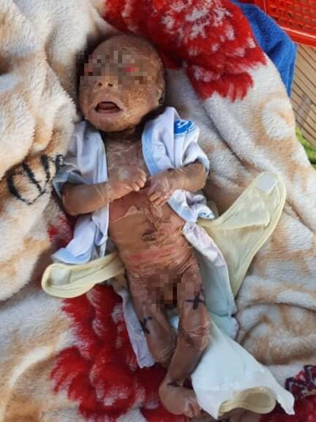 Tây Ninh: Bé trai chưa đầy 1 tháng tuổi, người đầy vảy ngứa như da trăn bị bố mẹ bỏ rơi ngoài đường - Ảnh 1