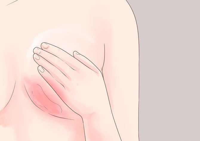 5 dấu hiệu nhận biết bệnh ung thư vú mà con gái không nên chủ quan xem thường - Ảnh 2