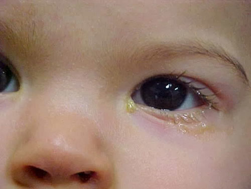 Trẻ bị đau mắt đỏ: 'Tất tần tật' về dấu hiệu, nguyên nhân, cách chăm sóc và phòng bệnh cho con cha mẹ nên biết - Ảnh 2