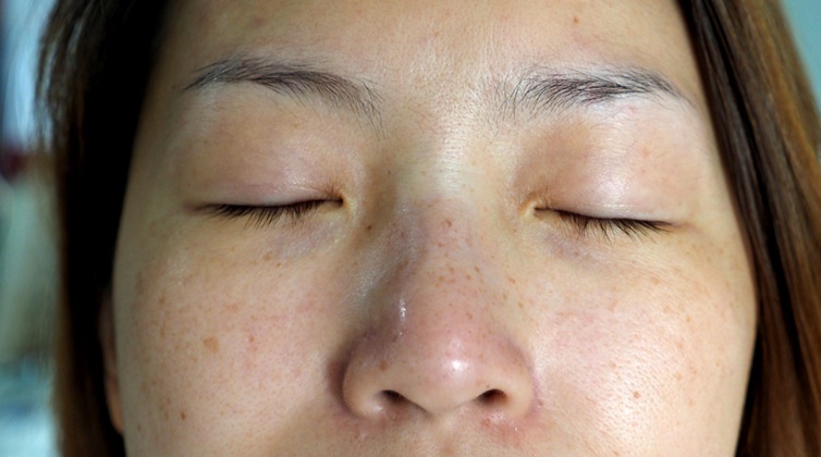 Những dưỡng chất được chuyên gia khuyên dùng để xóa sạch đốm đen, nám sạm và tàn nhang giúp da mặt trắng mịn, không tì vết - Ảnh 1
