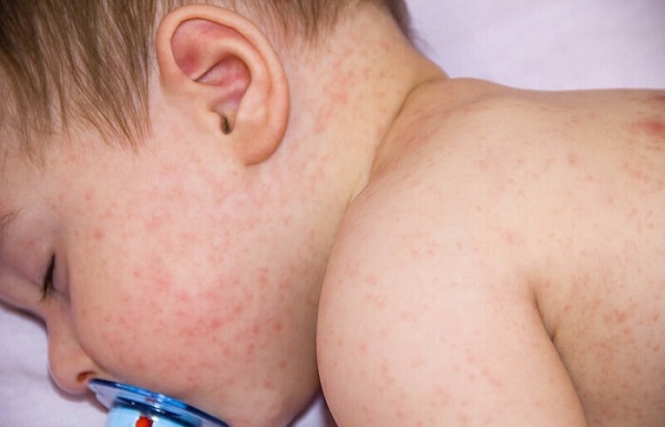 Những lưu ý bố mẹ cần biết khi chăm sóc trẻ bị sốt virus tại nhà - Ảnh 1