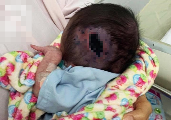 Sau 2 tuần điều trị tại Singapore, em bé sơ sinh bị bỏ rơi ở Lâm Đồng, đầu thủng và có giòi trong mũi đã hồi sinh kỳ diệu - Ảnh 1