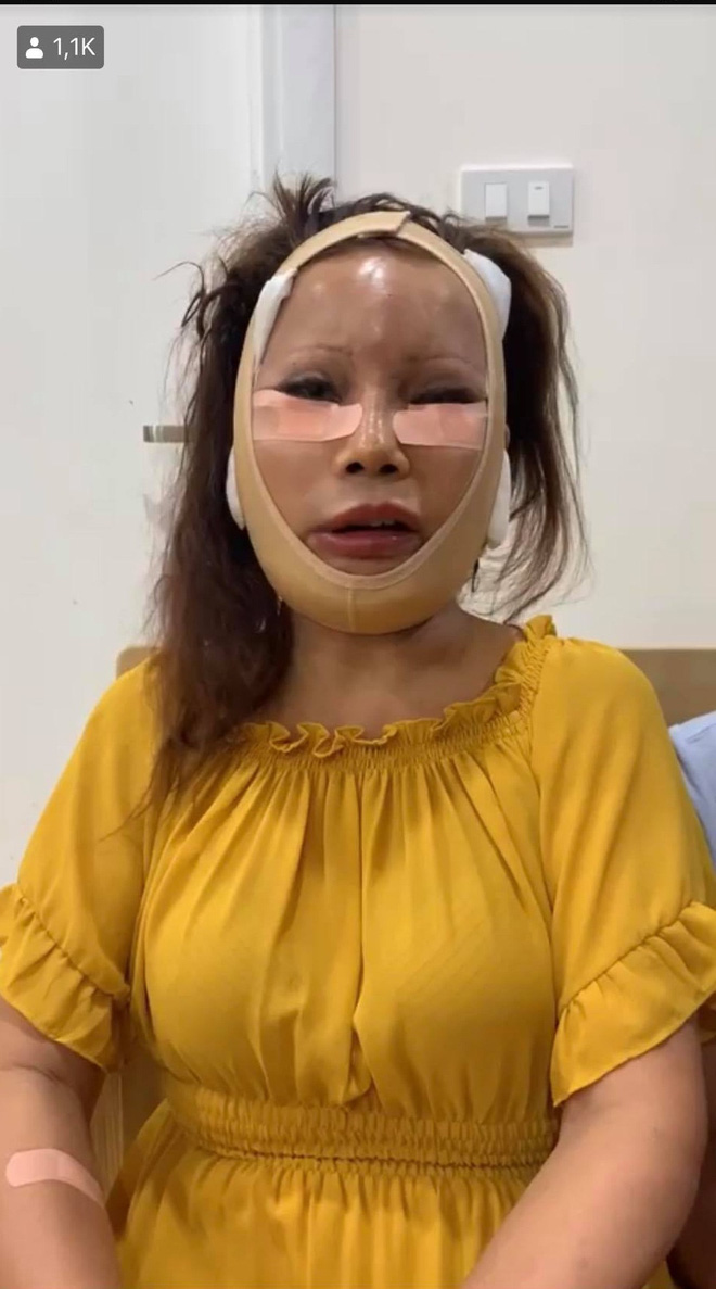Vừa nâng mũi, cô dâu 62 tuổi tiếp tục thẩm mỹ căng da, gương mặt sưng phù sau phẫu thuật khiến nhiều người choáng váng - Ảnh 2