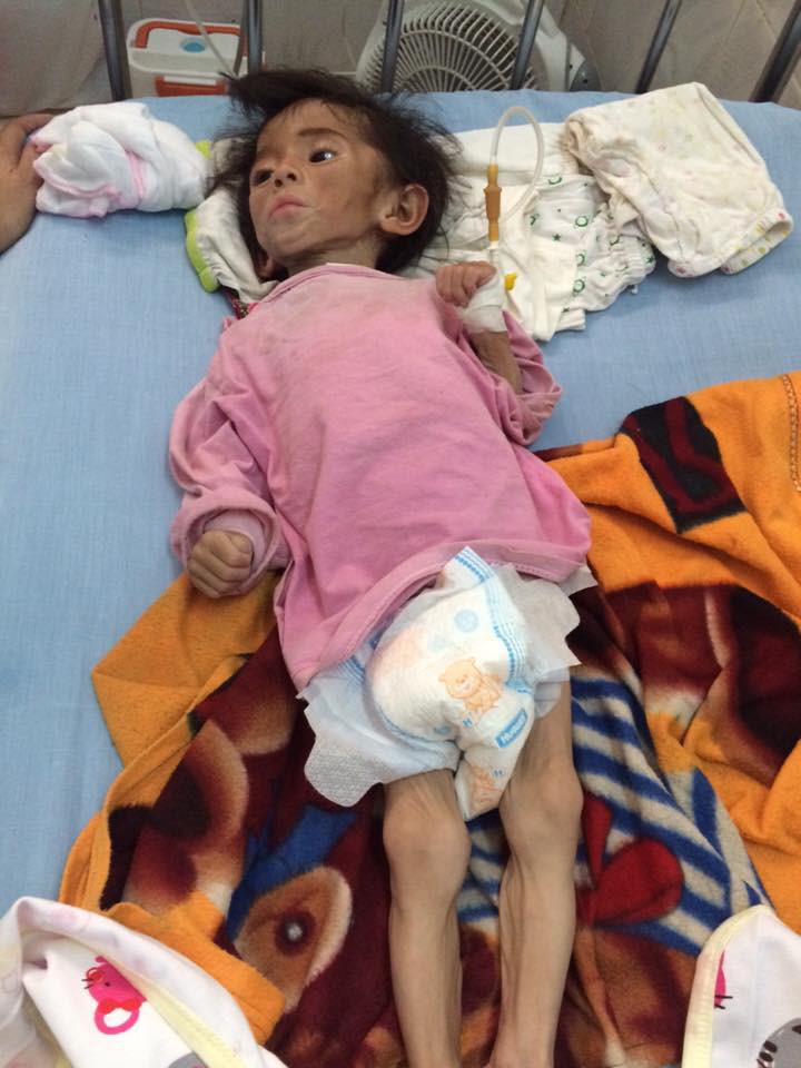 Hình ảnh mới nhất của bé gái Lào Cai bị suy dinh dưỡng: Cằm nhọn, cao lớn không nhận ra - Ảnh 1