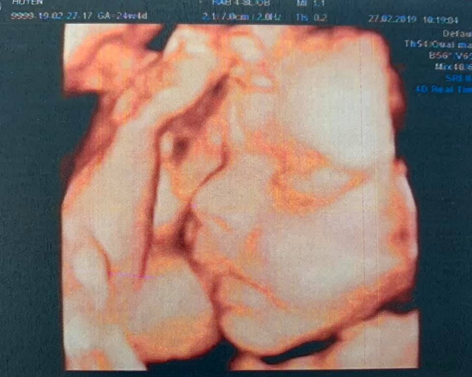Khoe ảnh siêu âm thai 5 tháng tuổi, Hải Băng tiết lộ giới tính và điểm đặc biệt về con thứ 3 - Ảnh 1