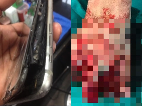 Nổ điện thoại iPhone vì vừa dùng vừa sạc, thiếu niên 13 tuổi phải cắt cụt bàn tay trái - Ảnh 1