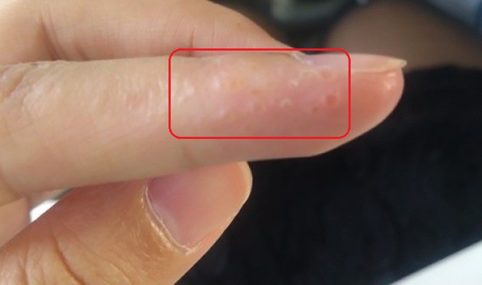 7 dấu hiệu cảnh báo bệnh nguy hiểm biểu hiện trên bàn tay của bạn - Ảnh 2