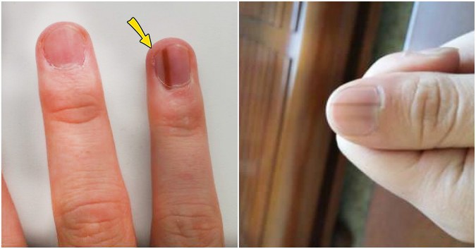 7 dấu hiệu cảnh báo bệnh nguy hiểm biểu hiện trên bàn tay của bạn - Ảnh 4