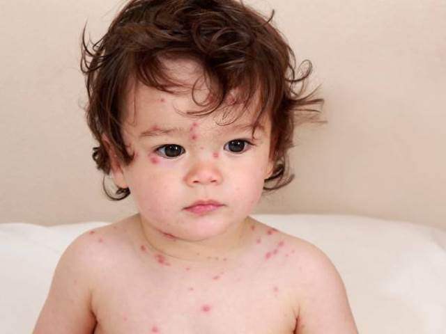 Mùa dịch bệnh thủy đậu ở trẻ em: Chi tiết cách điều trị và những kiêng kỵ - Ảnh 1