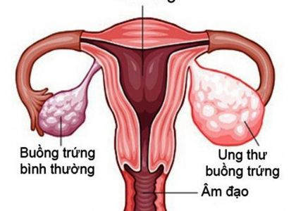 Ung thư buồng trứng: Dấu hiệu sớm của bệnh thường bị chị em ngó lơ - Ảnh 1