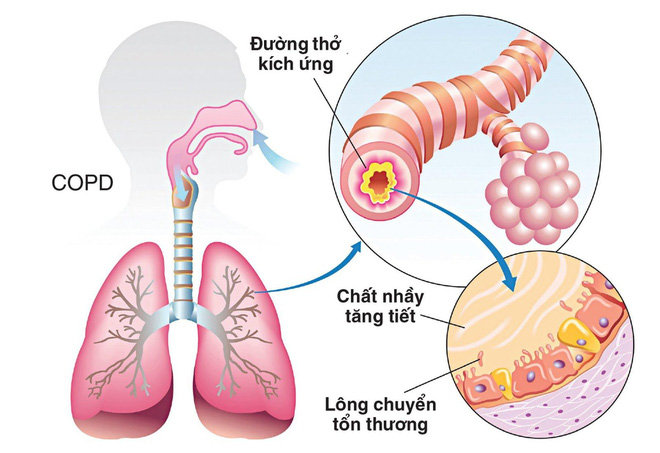 Nếu cơ thể có 2 chỗ lồi và 3 chỗ đen sạm: Bệnh phổi đang điểm danh bạn, hãy đi khám - Ảnh 1