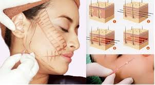 Cấy chỉ căng da mặt, người phụ nữ phải 'lột toàn bộ da mặt vùng cấy chỉ' để chữa trị - Ảnh 1