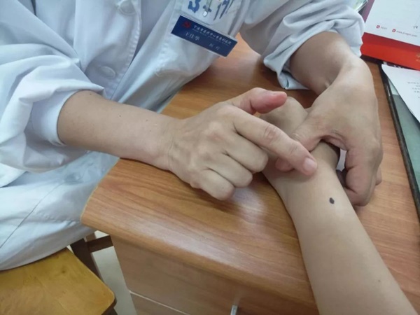 Cô gái 26 tuổi bị ung thư da sau khi làm việc này với nốt ruồi, bác sĩ cảnh báo những dấu hiệu ở nốt ruồi cần đi khám gấp - Ảnh 2