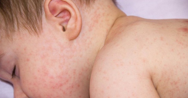 10 biểu hiện nguy hiểm và 5 nguyên tắc phòng bệnh trẻ sốt siêu vi - Ảnh 3