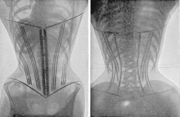 Đeo corset để giảm cân, giảm mỡ bụng sau sinh, một người bị bong tróc tử cung, nội tạng chảy xệ - Ảnh 5