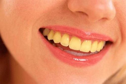 Cao răng, mảng bám, ố vàng sạch bách với 4 cách làm trắng răng từ 1 quả chanh - Ảnh 1