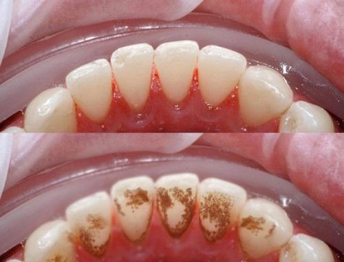 Cao răng, mảng bám, ố vàng sạch bách với 4 cách làm trắng răng từ 1 quả chanh - Ảnh 12