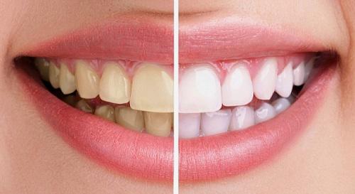 Cao răng, mảng bám, ố vàng sạch bách với 4 cách làm trắng răng từ 1 quả chanh - Ảnh 2