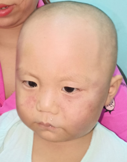 Dỗ mãi không nín, bé 19 tháng tuổi bị cô giáo đánh sưng mặt phải nhập viện - Ảnh 2