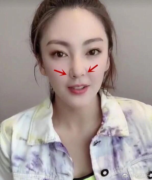 ‘Song Hye Kyo Trung Quốc’ - Trương Vũ Kỳ lộ biến chứng phẫu thuật thẩm mỹ khiến nhiều người ‘phát hoảng’ - Ảnh 5