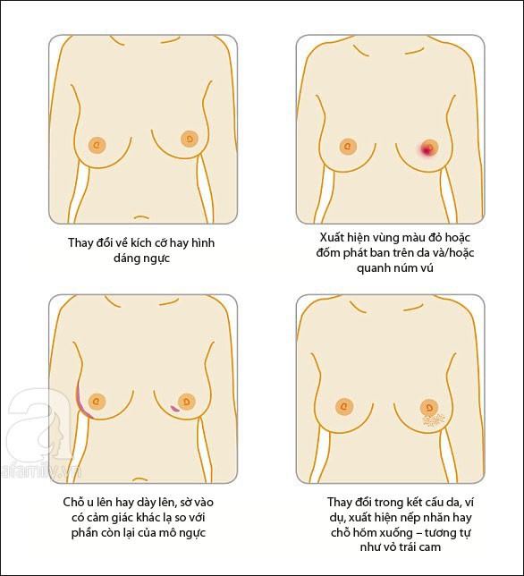 Dù ngực không có khối u nhưng nếu thấy có biểu hiện như trong bức tranh này thì bạn nên đi khám ung thư vú ngay kẻo muộn - Ảnh 3