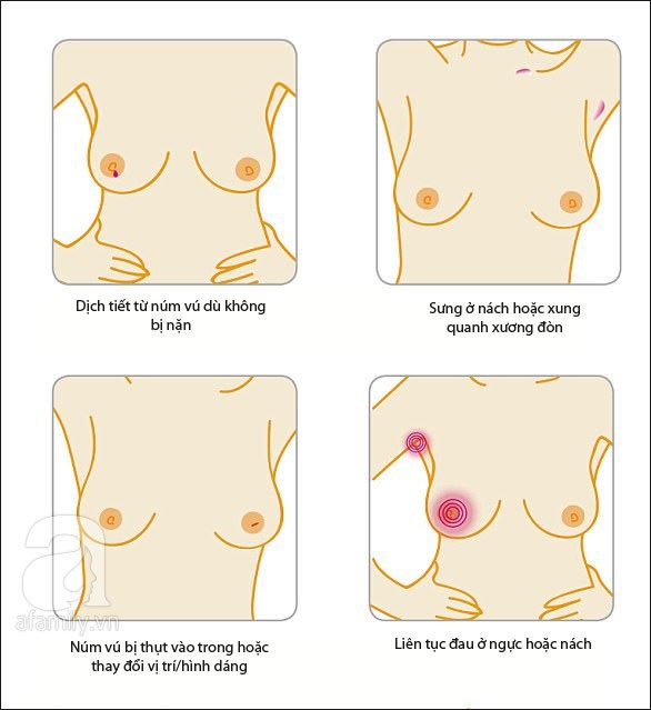 Dù ngực không có khối u nhưng nếu thấy có biểu hiện như trong bức tranh này thì bạn nên đi khám ung thư vú ngay kẻo muộn - Ảnh 4