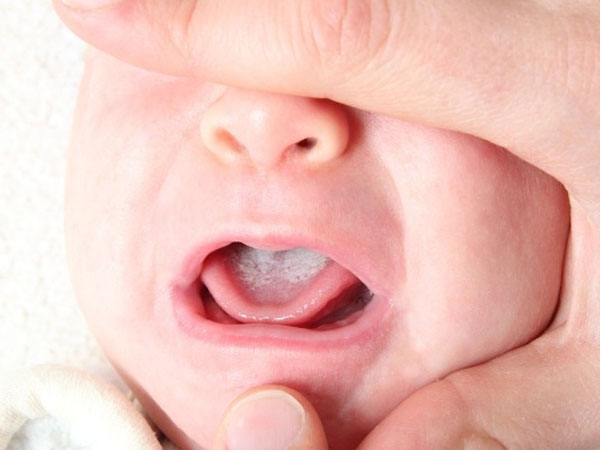 trẻ sơ sinh bị viêm họng 3