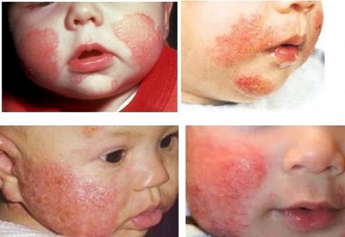 Những bệnh ngoài da thường gặp ở trẻ sơ sinh - Ảnh 1