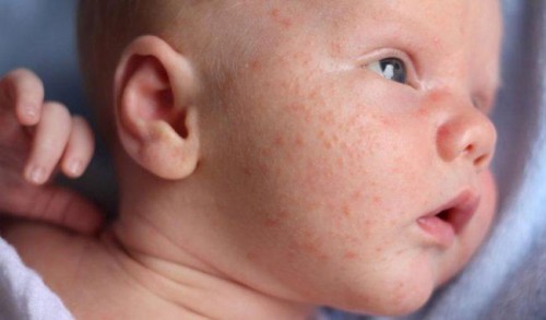 Những bệnh ngoài da thường gặp ở trẻ sơ sinh - Ảnh 2